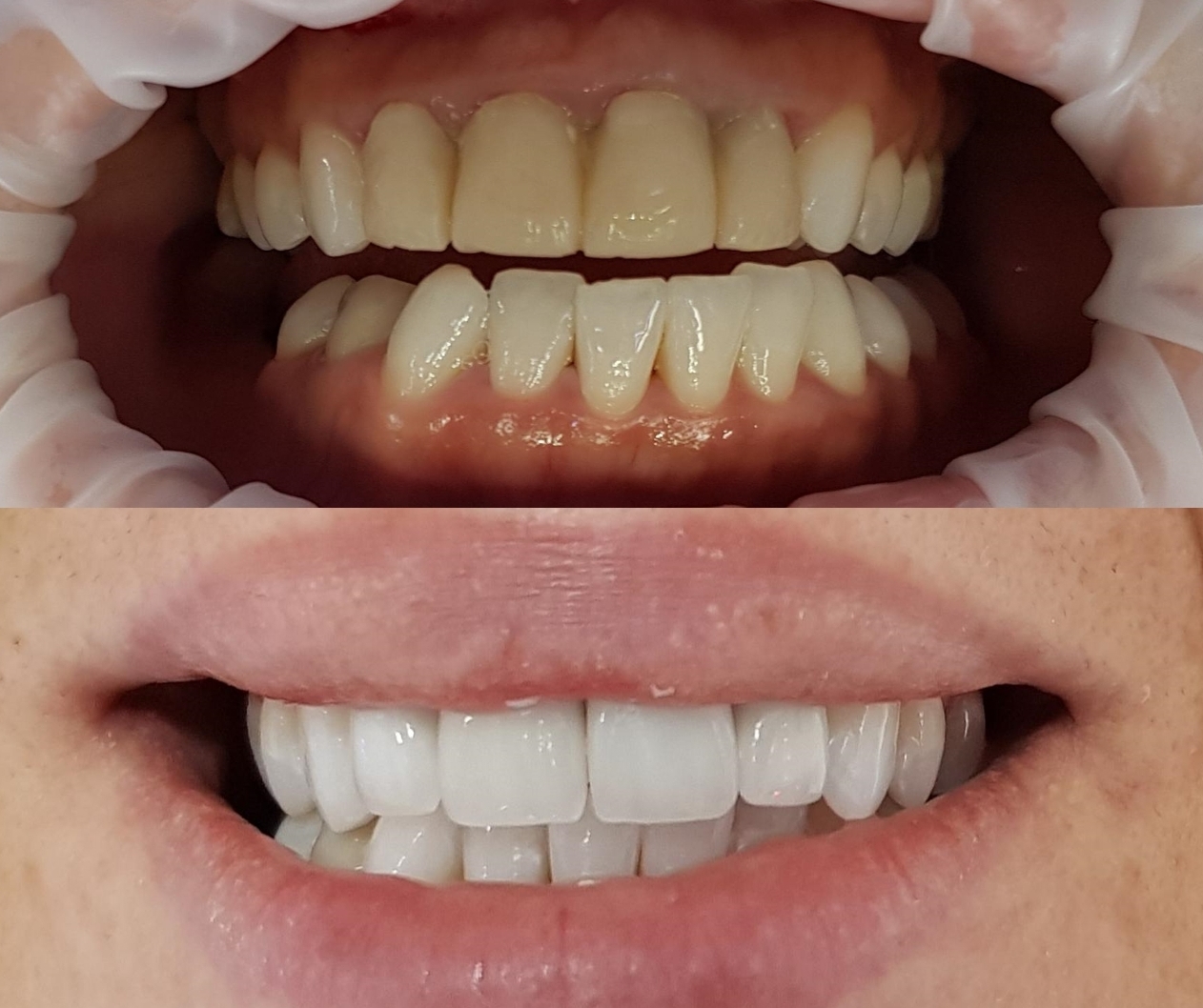 Couronne dentaire céramique - Pour un résultat naturel